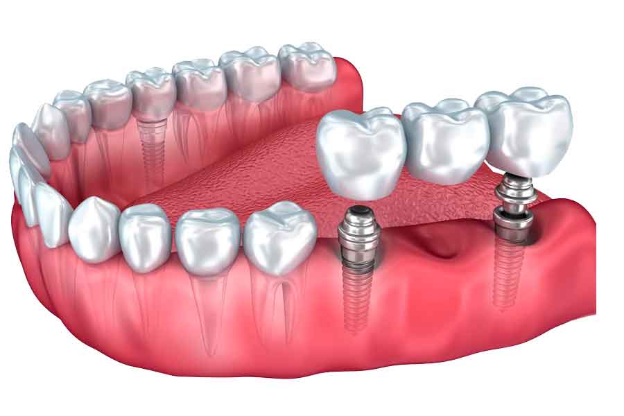 Современные технологии в стоматологии: протезирование, имплантация и отбеливание